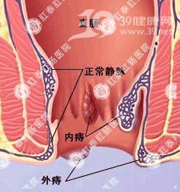 痔疮易引起的“五宗罪”